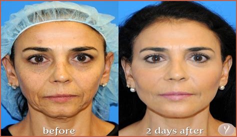 the non-invasive facelift procedure explained